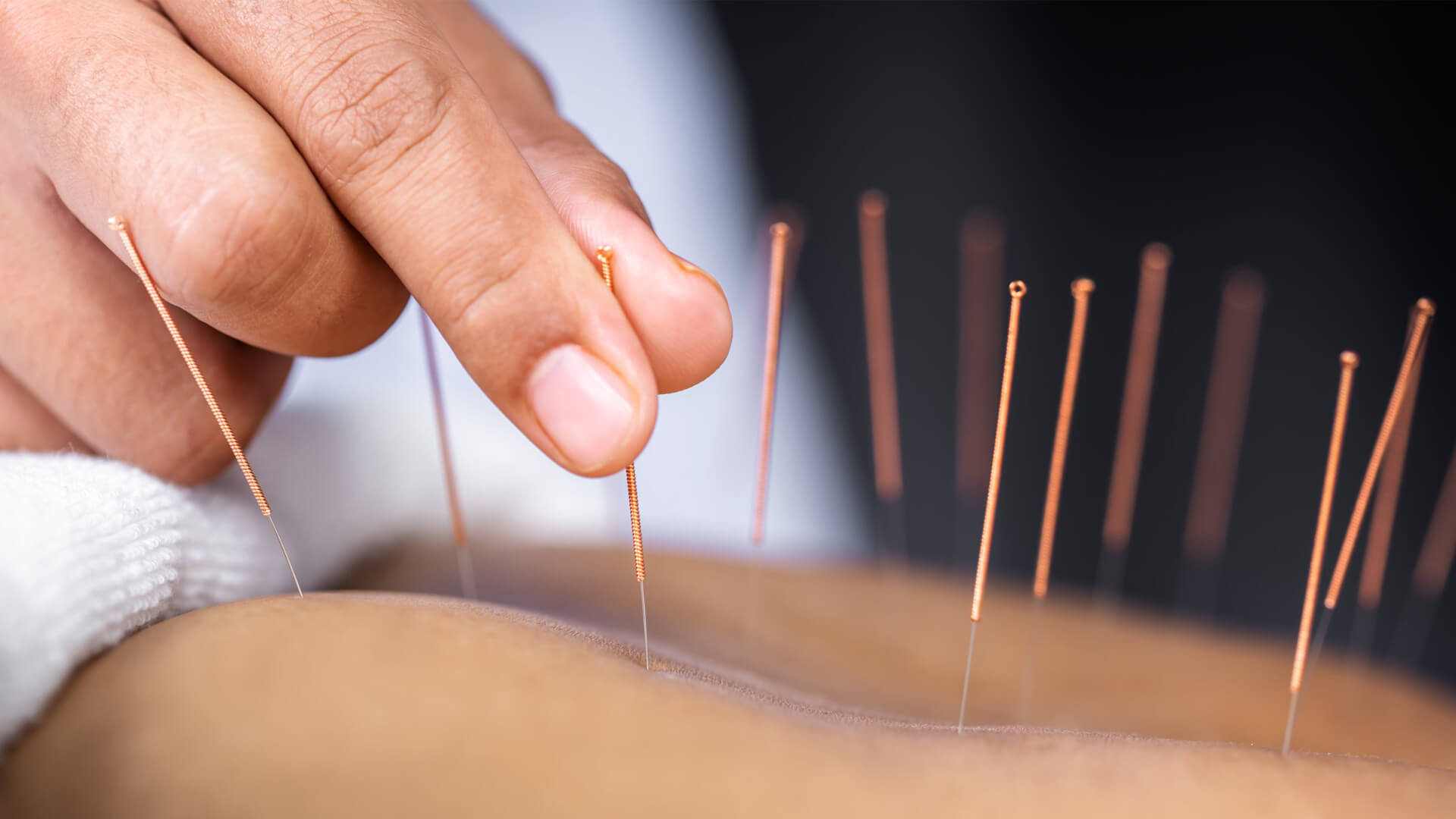 Village Physio & Sports Injury Clinic. Physio in Adelaide image of a woman having dry needling done on her back by a physiotherapist.