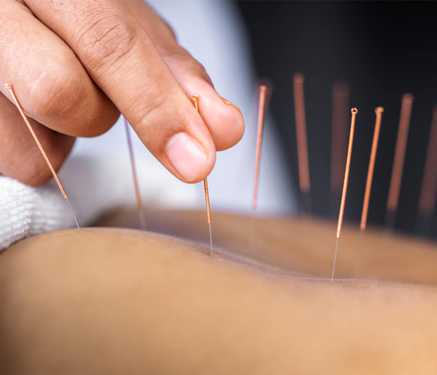 Village Physio & Sports Injury Clinic. Physio Golden Grove image of a woman having dry needling done on her back by a physiotherapist.